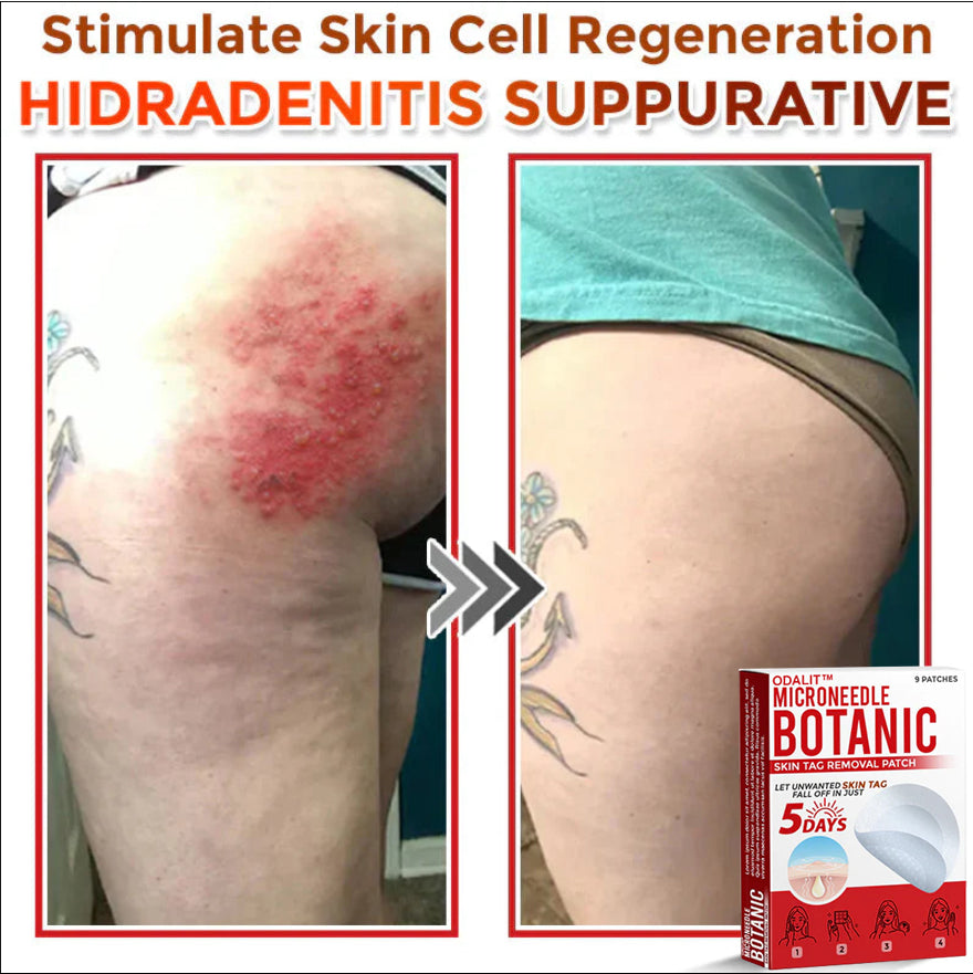 👩‍⚕️𝑶𝒇𝒇𝒊𝒄𝒊𝒂𝒍 𝑺𝒕𝒐𝒓𝒆 | ODALIT™ Gentle Microneedle Patches for Skin Tag & Mole Removal