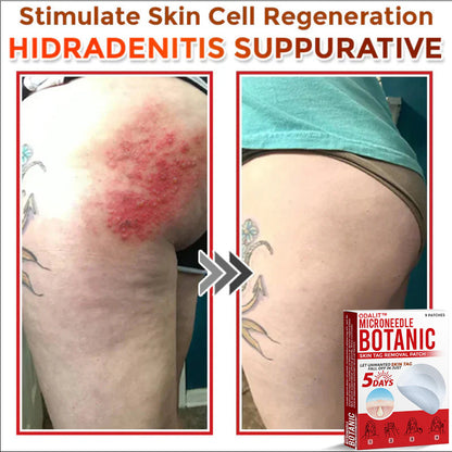 👩‍⚕️𝑶𝒇𝒇𝒊𝒄𝒊𝒂𝒍 𝑺𝒕𝒐𝒓𝒆 | ODALIT™ Gentle Microneedle Patches for Skin Tag & Mole Removal