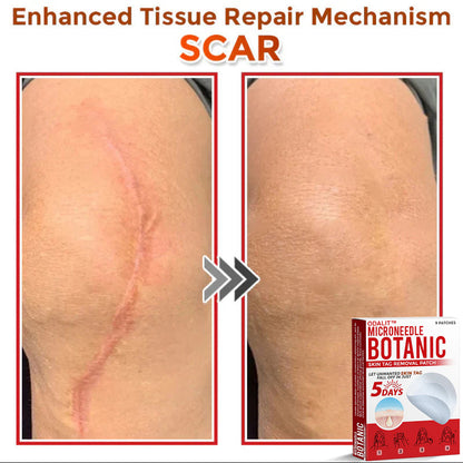 👩‍⚕️𝑶𝒇𝒇𝒊𝒄𝒊𝒂𝒍 𝑺𝒕𝒐𝒓𝒆 | ODALIT™ Gentle Microneedle Patches for Skin Tag & Mole Removal